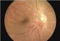 Камера Fundus офтальмоскопа H.264 цифров осмотра