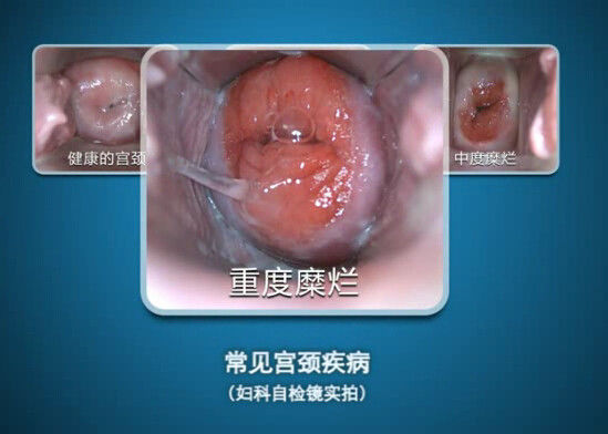 Эндоскопе цифров Само-проверяет Колпоскопы Колпоскопе мини с рядом замечания 70~100мм