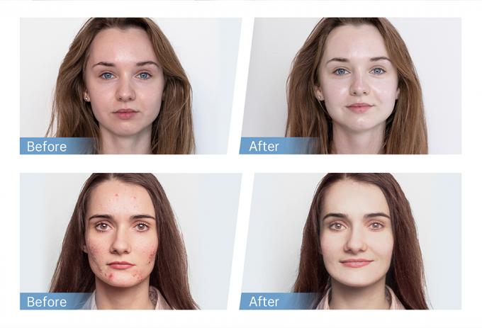 Заводская распродажа Hydra Pen H5 EMS Электрическая ручка для микроигольчатой терапии для регенерации коллагена, роста волос и бороды, для домашнего и салонного использования 4